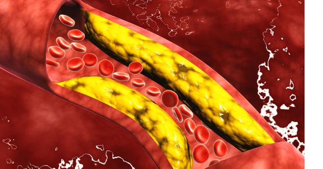 một cơn đau tim hoặc đột quỵ có thể là kết quả của cholesterol máu cao.