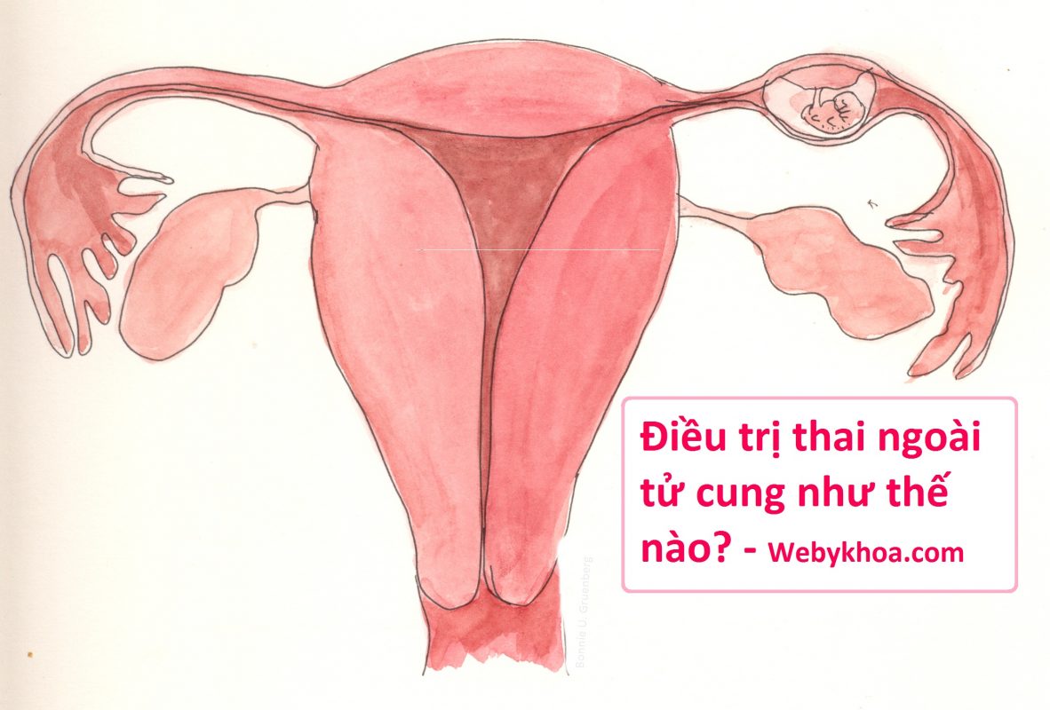 Thai ngoài tử cung được điều trị như thế nào